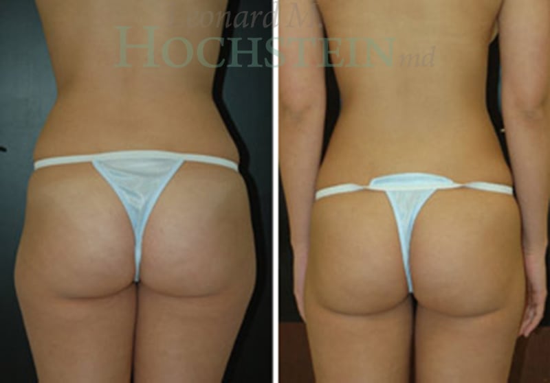 Liposuction Patient