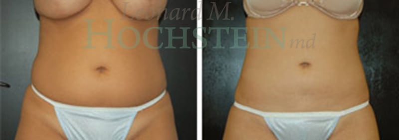 Liposuction Patient