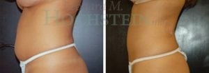 Liposuction Patient 20a
