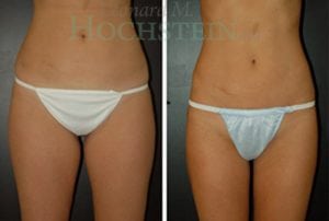 Liposuction Patient 21