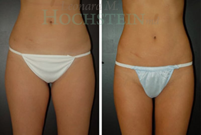 Liposuction Patient
