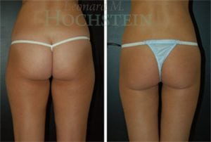 Liposuction Patient 21a
