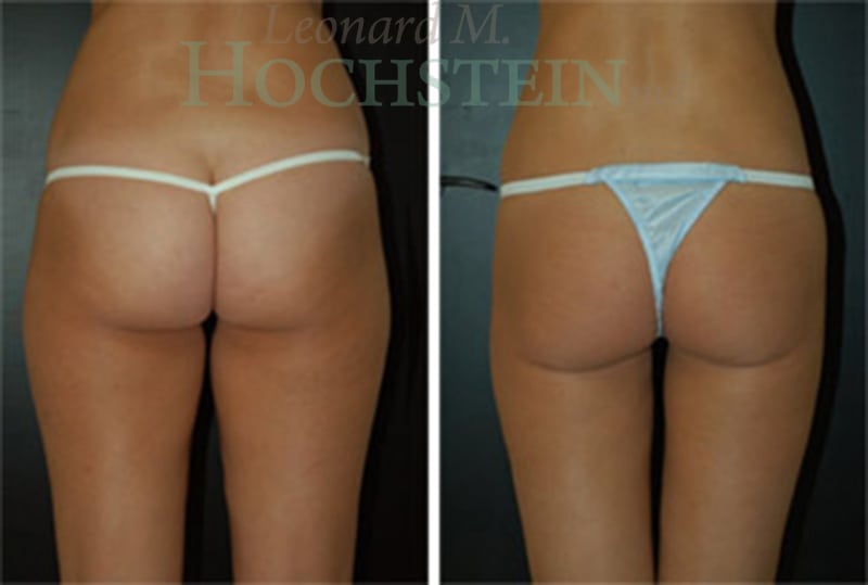 Liposuction Patient