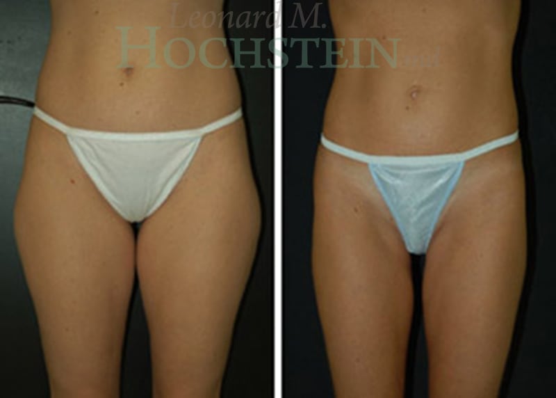 Liposuction Patient