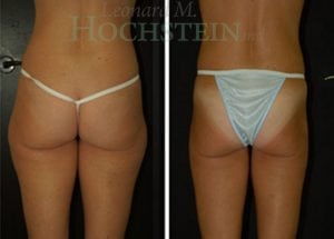 Liposuction Patient 22a