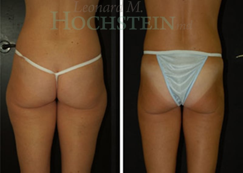 Liposuction Patient