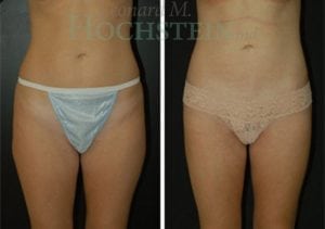 Liposuction Patient 24