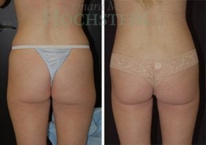 Liposuction Patient 24a