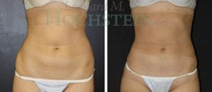 Liposuction Patient 25