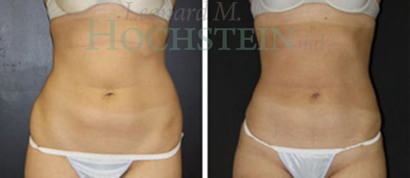 Liposuction Patient
