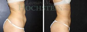 Liposuction Patient 25a
