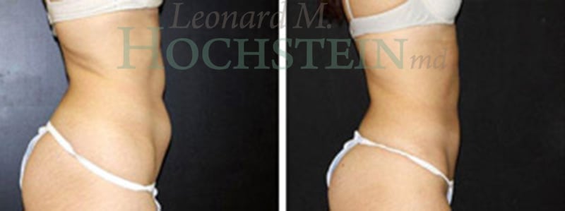 Liposuction Patient