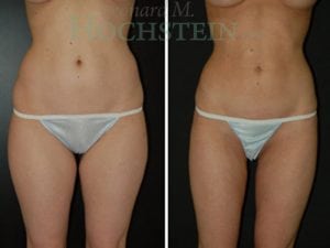 Liposuction Patient 26