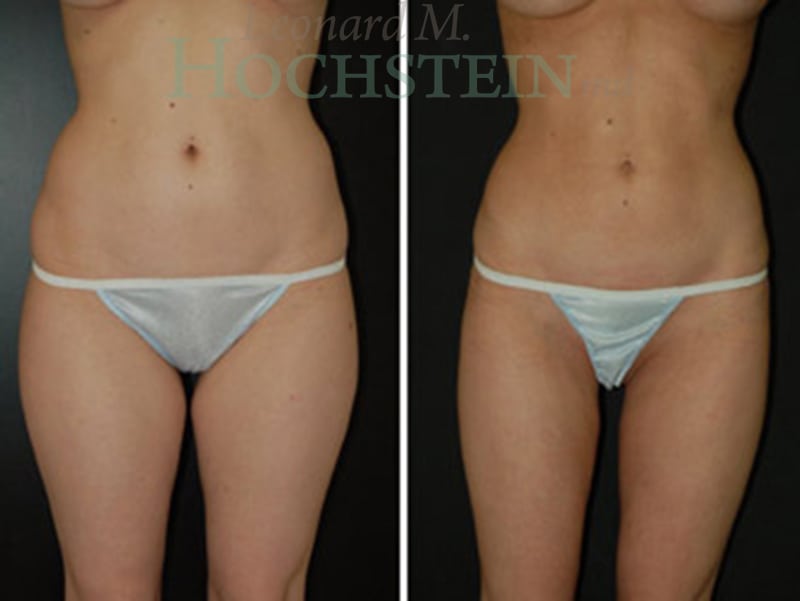 Liposuction Patient