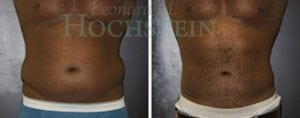 Liposuction Patient 27
