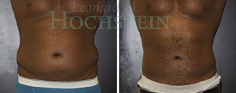 Liposuction Patient