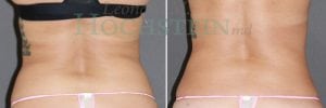 Liposuction Patient 38a