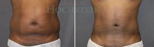 Liposuction Patient 41