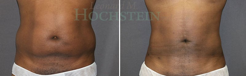 Liposuction Patient