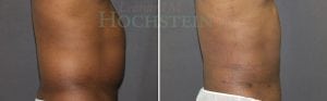 Liposuction Patient 41a