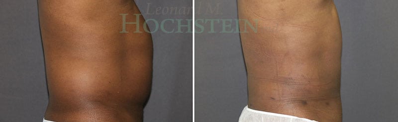 Liposuction Patient