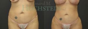 Liposuction Patient 46
