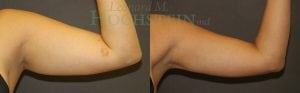 Liposuction Patient 39
