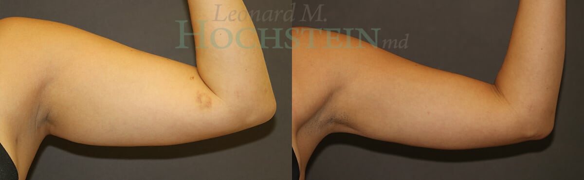 Liposuction Patient