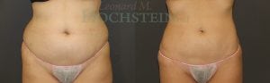 Liposuction Patient 40