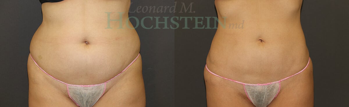 Liposuction Patient