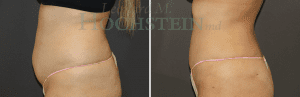 Liposuction Patient 40a
