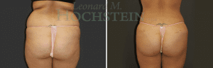 Liposuction Patient 40b