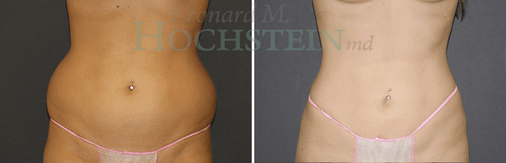 Liposuction Patient