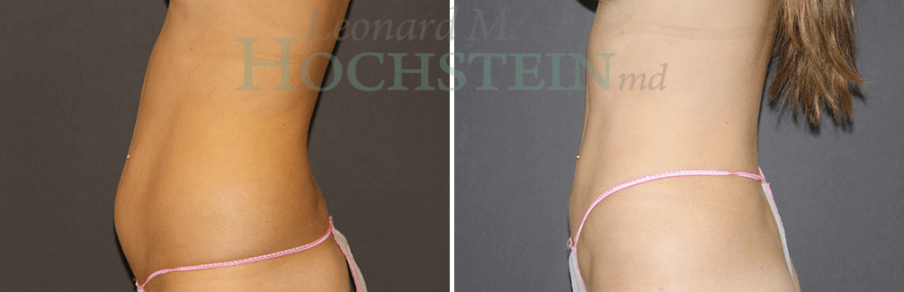 Liposuction Patient