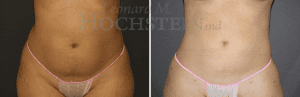 Liposuction Patient 43