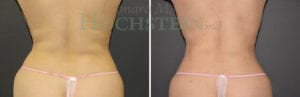 Liposuction Patient 47