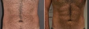 Liposuction Patient 48