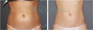 Liposuction Patient 29