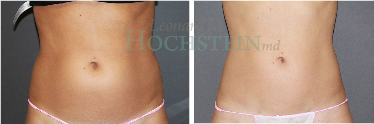 Liposuction Patient