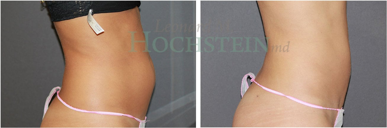Liposuction Patient