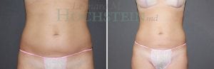 Liposuction Patient 28
