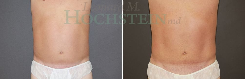 Liposuction Patient
