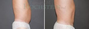Liposuction Patient 30a