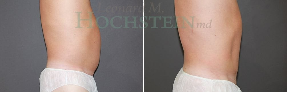 Liposuction Patient