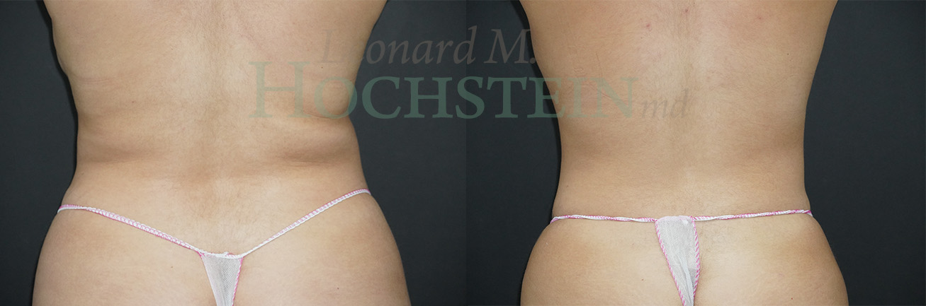 Liposuction Patient