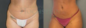 Liposuction Patient