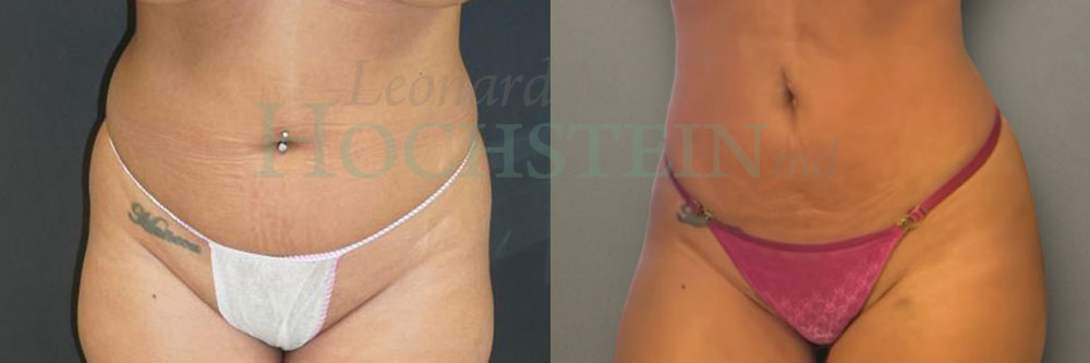 Liposuction Patient