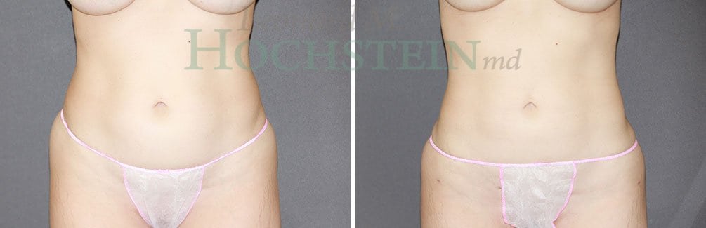 Liposuction Patient