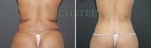 Liposuction Patient 49