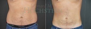 Liposuction Patient